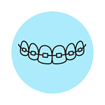 Metal Braces