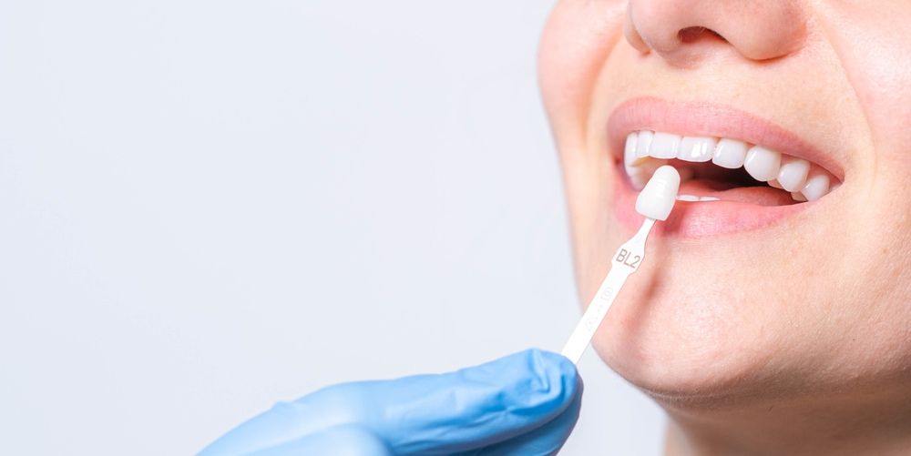 การทำวีเนียร์แก้ปัญหาสุขภาพฟันอย่างไรได้บ้าง