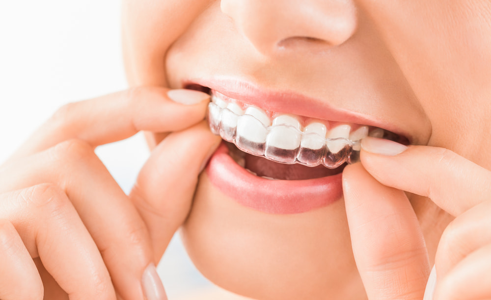 Pros and Cons of Invisalign Aligners