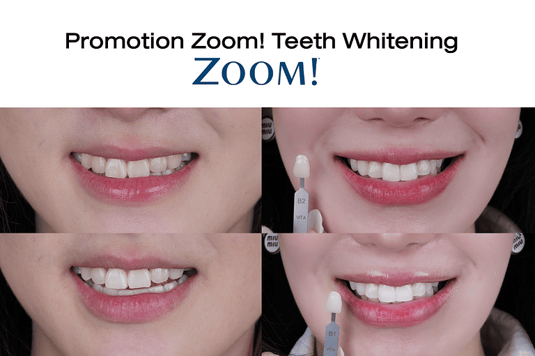 ZoomTeeth-Whitening -Promotion