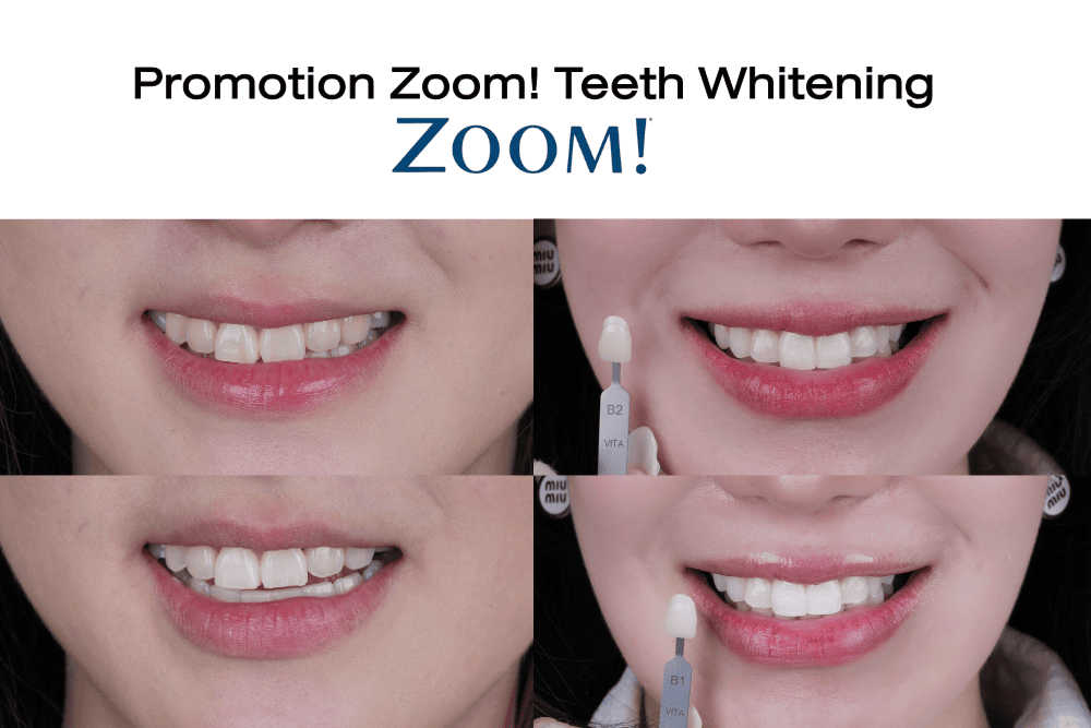 ZoomTeeth-Whitening -Promotion