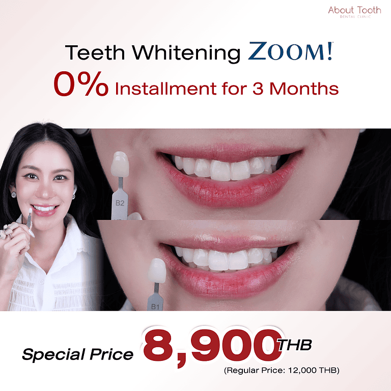 Zoom-Teeth-Whitening -Promotion