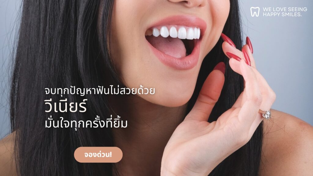 Veneer 