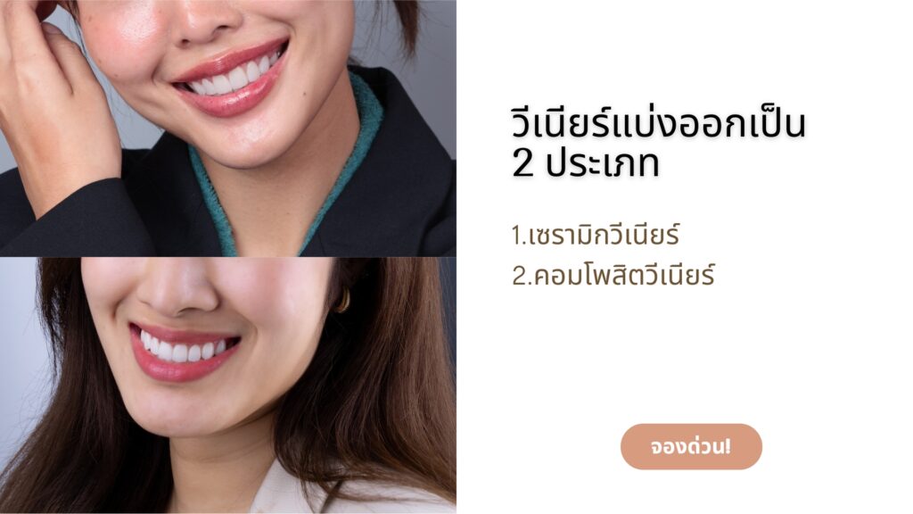 Veneer 