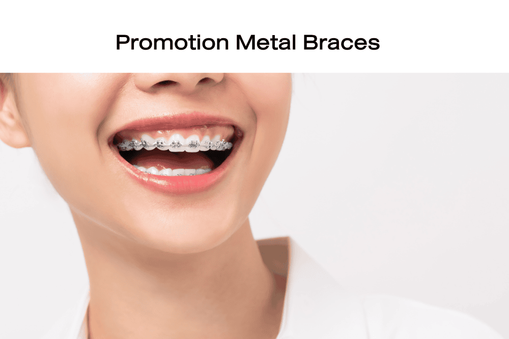 Read more about the article Metal Braces (Traditional Braces)