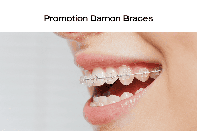 Damon-Braces