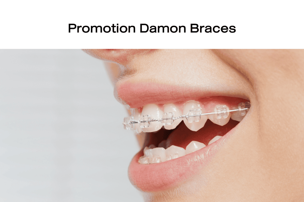 Read more about the article Promotion Damon Braces