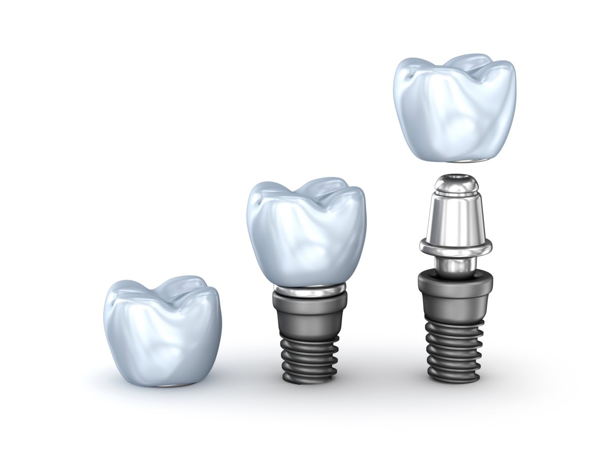 A dental implant, abutment and crown.