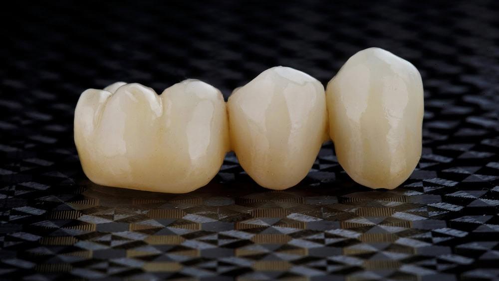 A dental bridge supports a replacement tooth