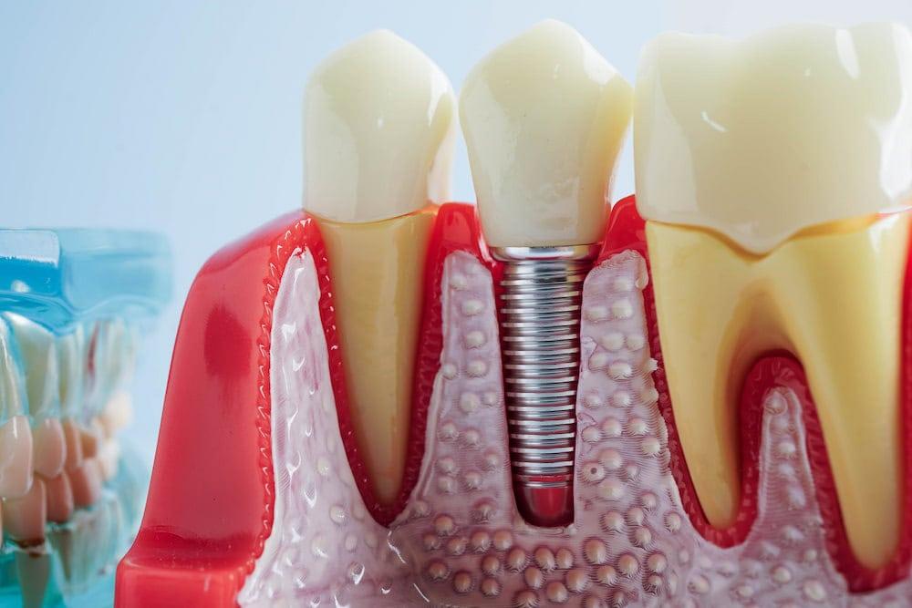 Read more about the article Missing Teeth Replacement