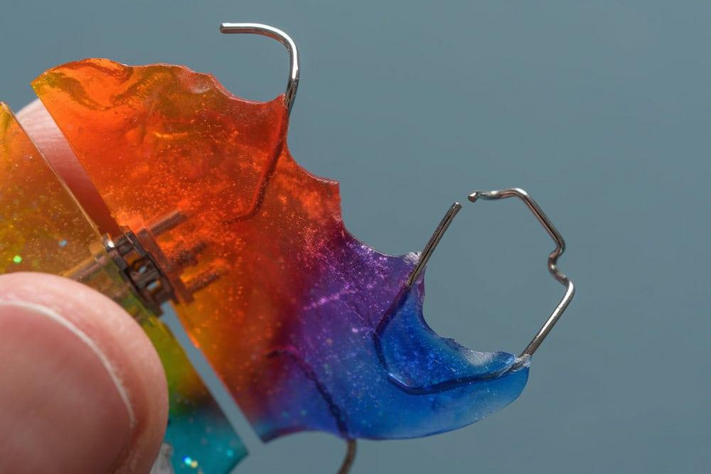 ตัวอย่างรีเทนเนอร์หักตรงลวดที่ควรซ่อมแซมโดยด่วน