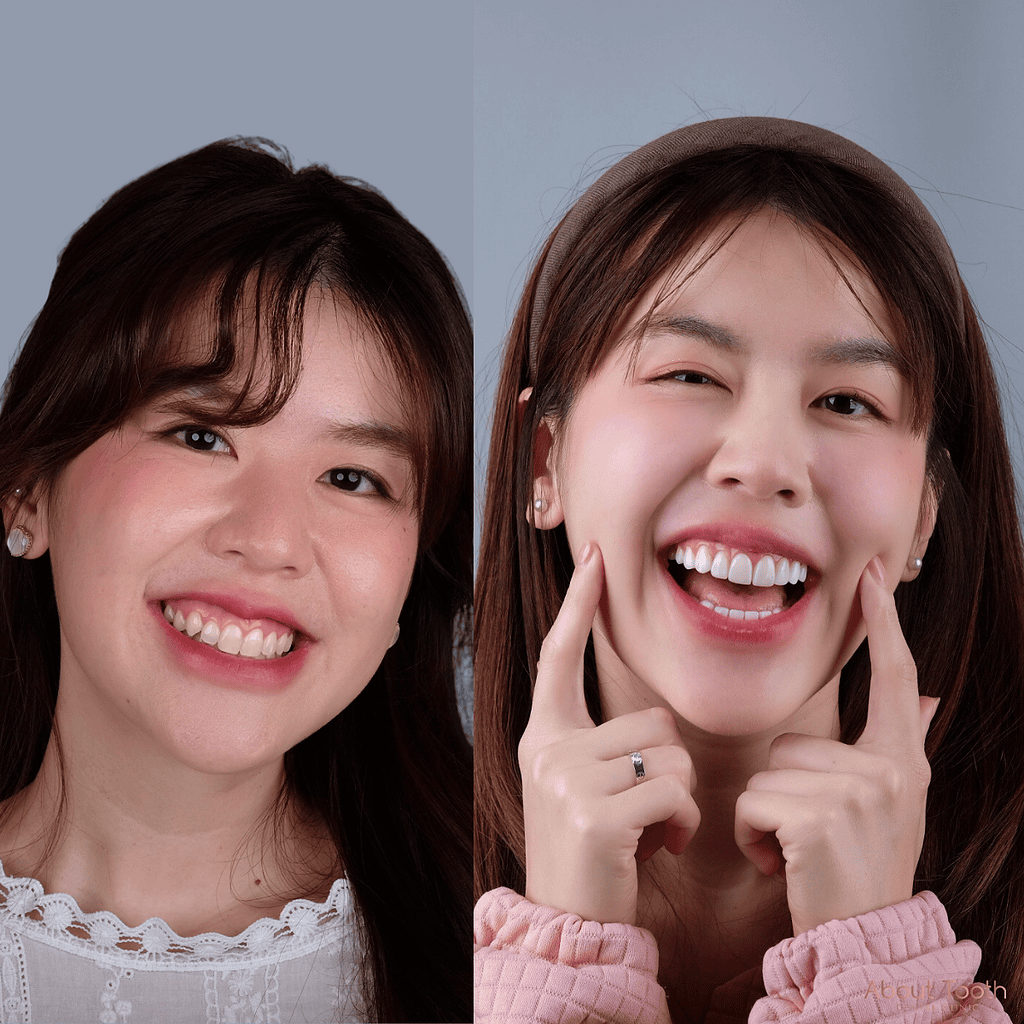 ning-veneer