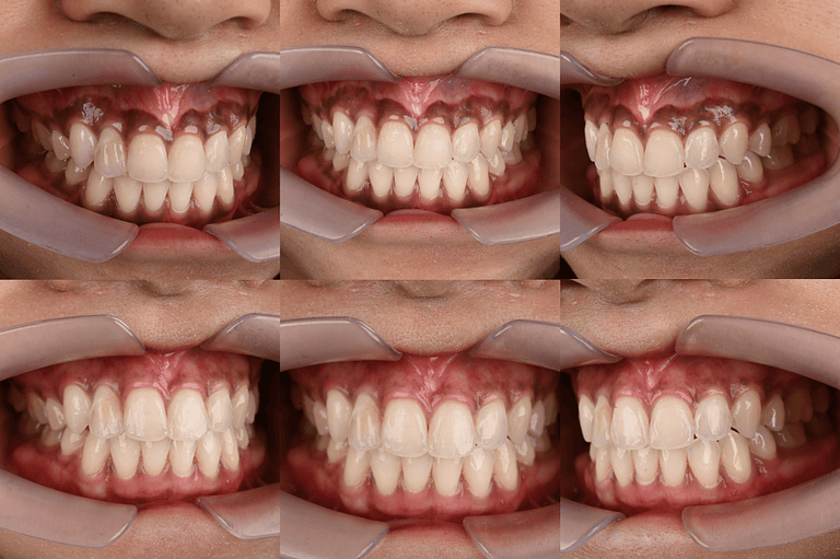 gum-laser-depigmentation