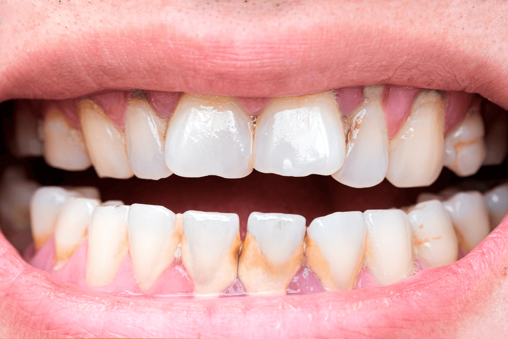 Tooth-Erosion