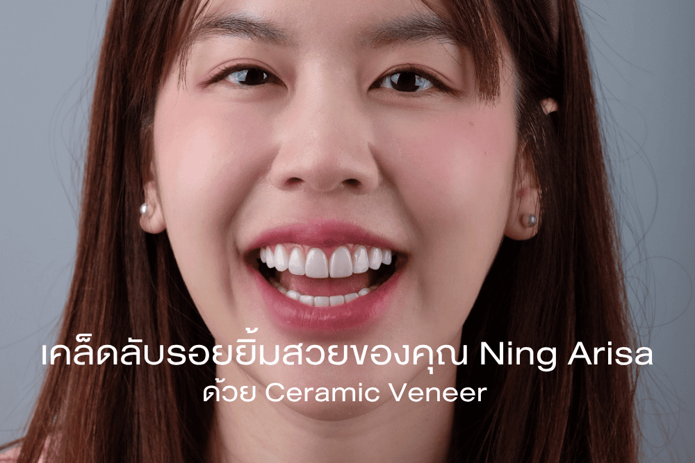 ning-veneer