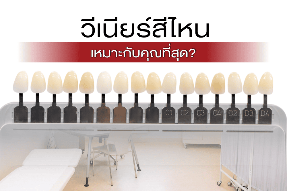 เลือกสีวีเนียร์แบบไหนดี?