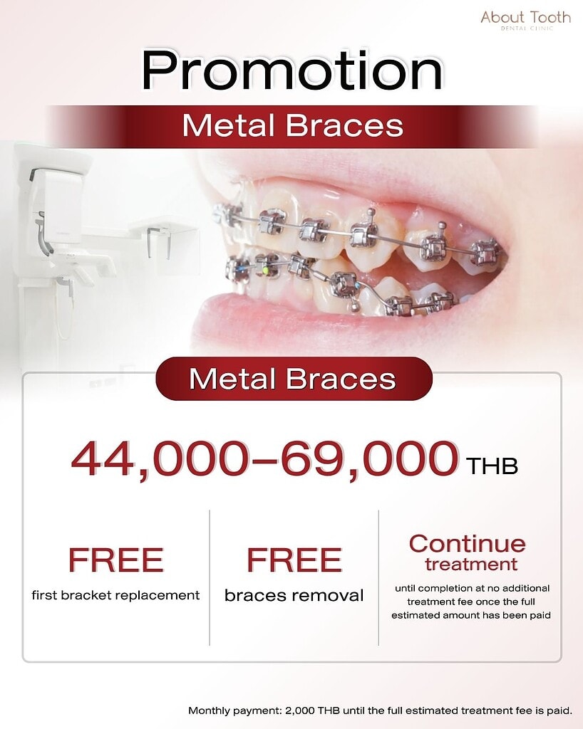 Metal-Braces-Price