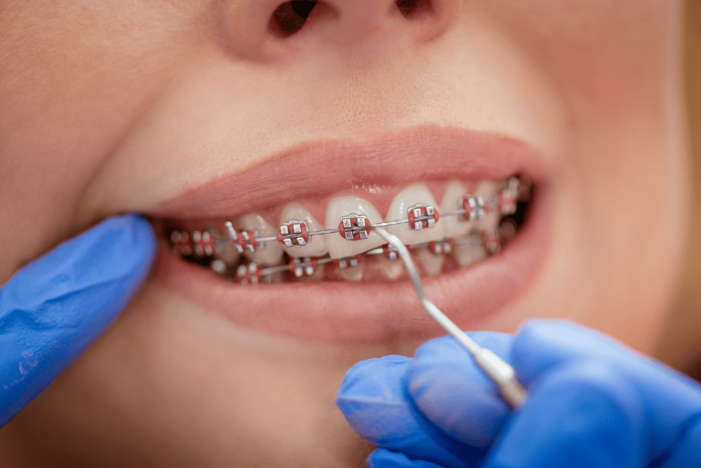 Metal-Braces
