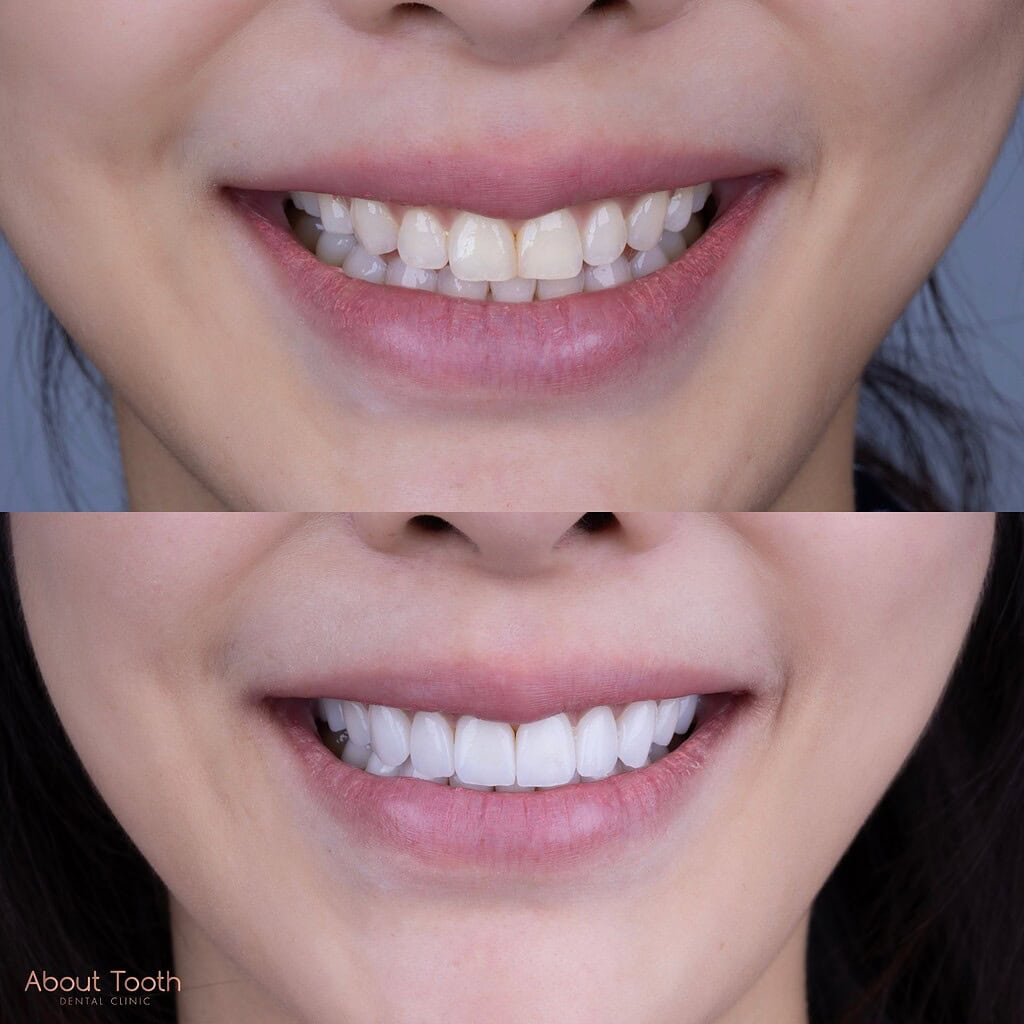 ceramic-veneer