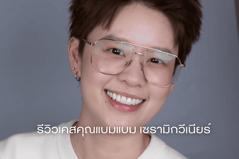 kbambam-ceramic-veneer-case-review